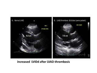 increased LVIDd after LVAD thrombosis
 