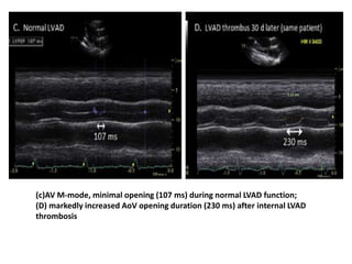 (c)AV M-mode, minimal opening (107 ms) during normal LVAD function;
(D) markedly increased AoV opening duration (230 ms) after internal LVAD
thrombosis
 