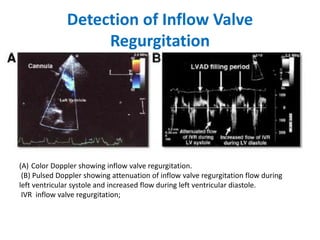 Detection of Inflow Valve
Regurgitation
(A) Color Doppler showing inflow valve regurgitation.
(B) Pulsed Doppler showing attenuation of inflow valve regurgitation flow during
left ventricular systole and increased flow during left ventricular diastole.
IVR inflow valve regurgitation;
 