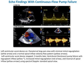 Echo Findings With Continuous-Flow Pump Failure
Left ventricular assist device on: Parasternal long-axis view with minimal mitral regurgitation
(white arrow) and a normal apical inflow velocity flow pattern (yellow arrows).
Left ventricular assist device stopped: 2 months later, VentrAssist (Ventracor) pump failure with
regurgitant inflow (yellow *), increased mitral regurgitation (red arrow), and reversal of apical
inflow (yellow arrows) using spectral Doppler standard apical view.
 