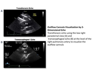 Outflow Cannula Visualization by 2-
Dimensional Echo
Transthoracic echo using the low right
parasternal view (A) and
transesophageal echo (B) at the level of the
right pulmonary artery to visualize the
outflow cannula
 