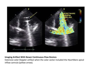 Imaging Artifact With Newer Continuous-Flow Devices
Extensive color Doppler artifact when the color sector included the HeartWare apical
inflow cannula (yellow arrow).
 