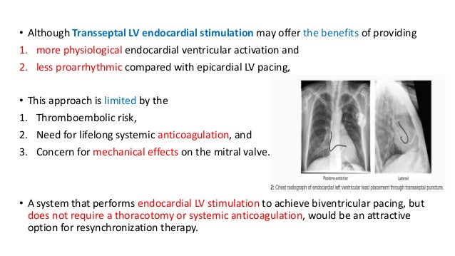 C.R.T - Wireless L.V Endocardial Pacing - The SELECT - LV study