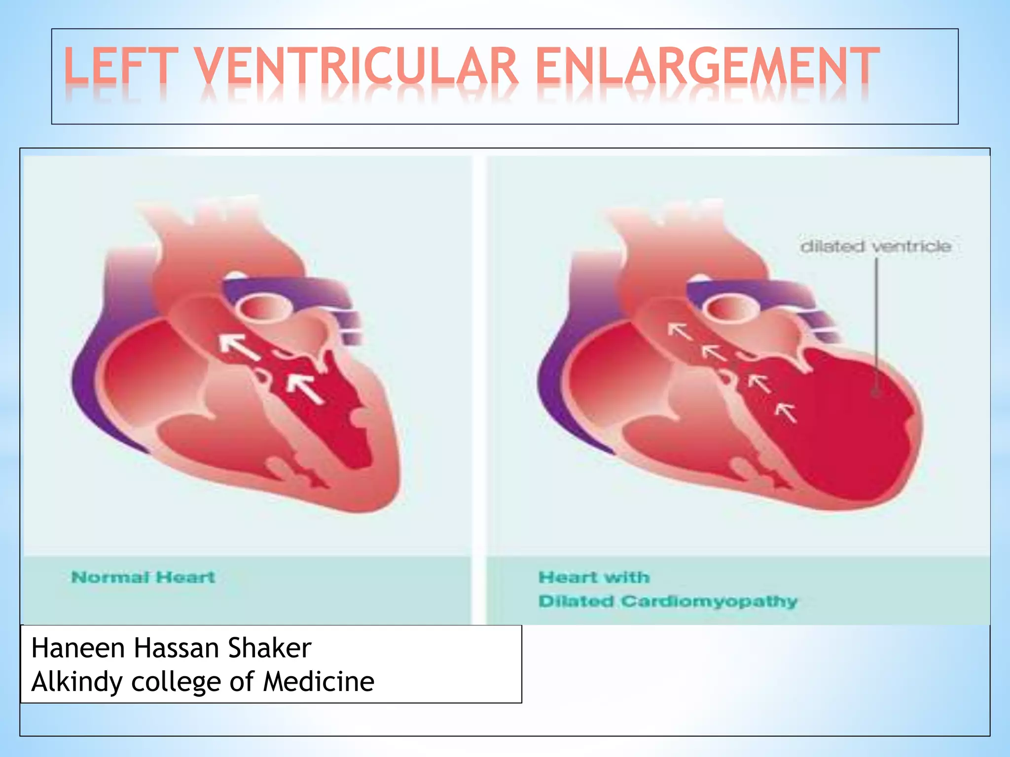 Left ventricular enlargement radiology | PPTX