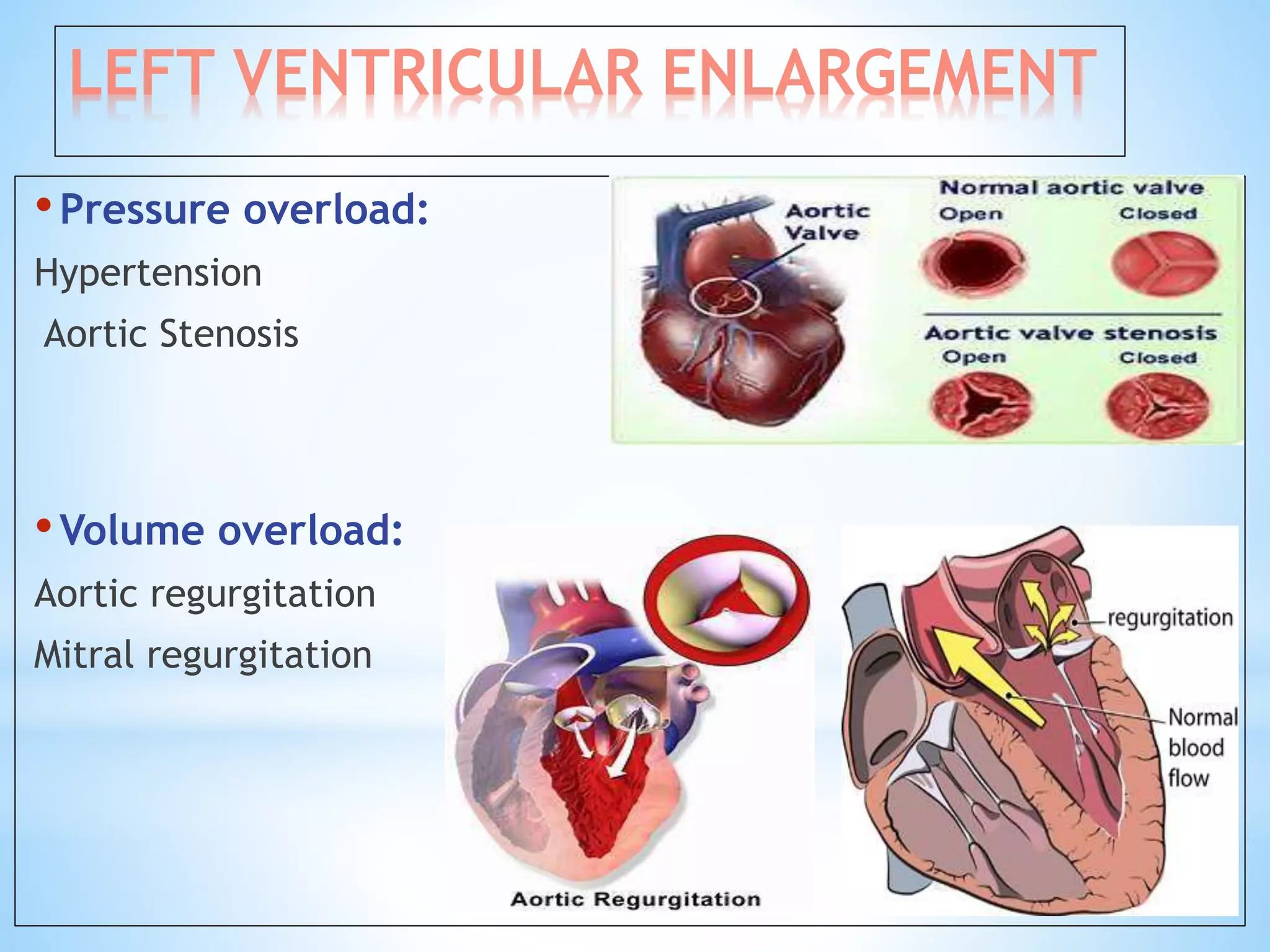Left ventricular enlargement radiology | PPTX