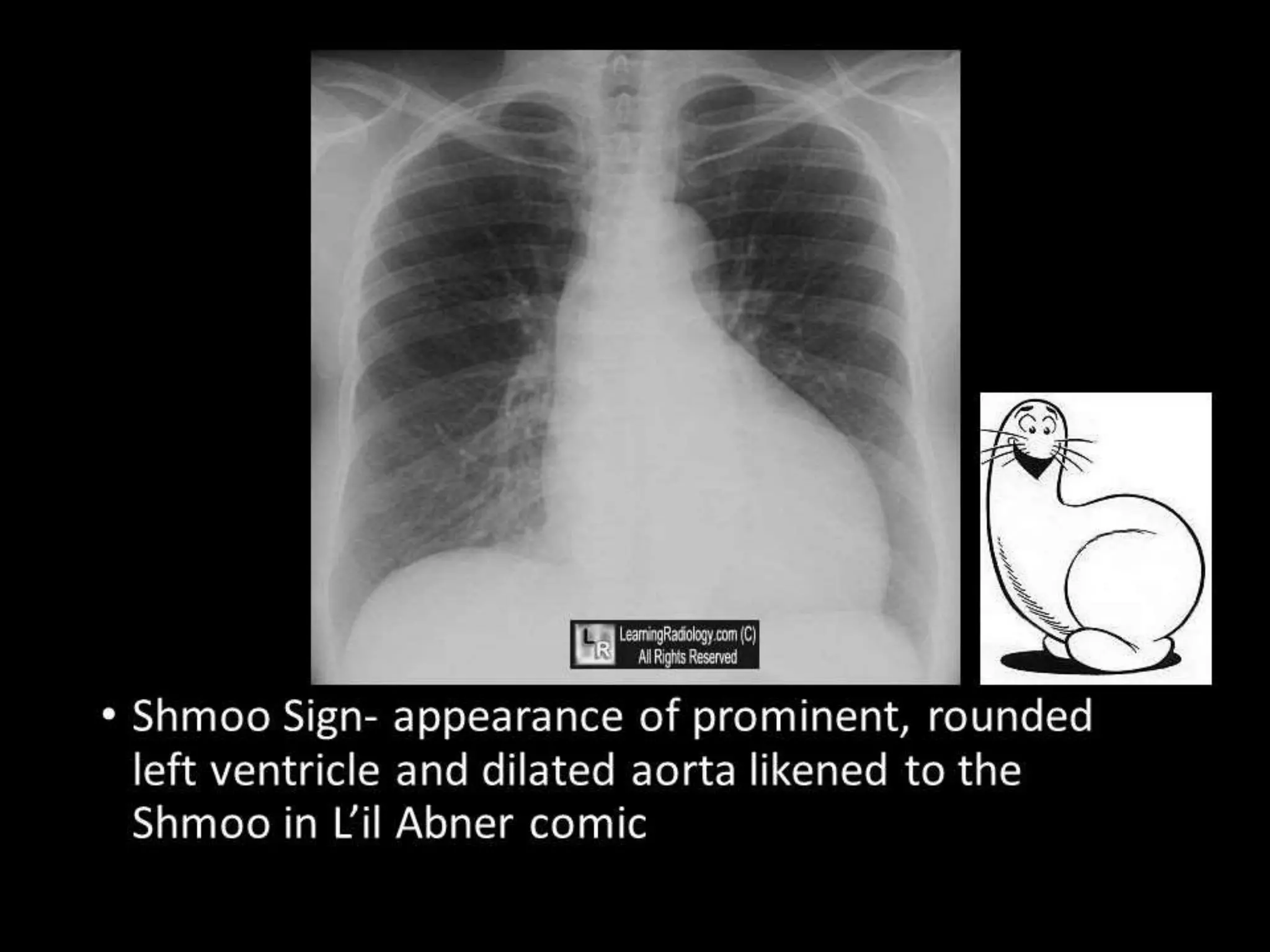 Left ventricular enlargement radiology | PPTX