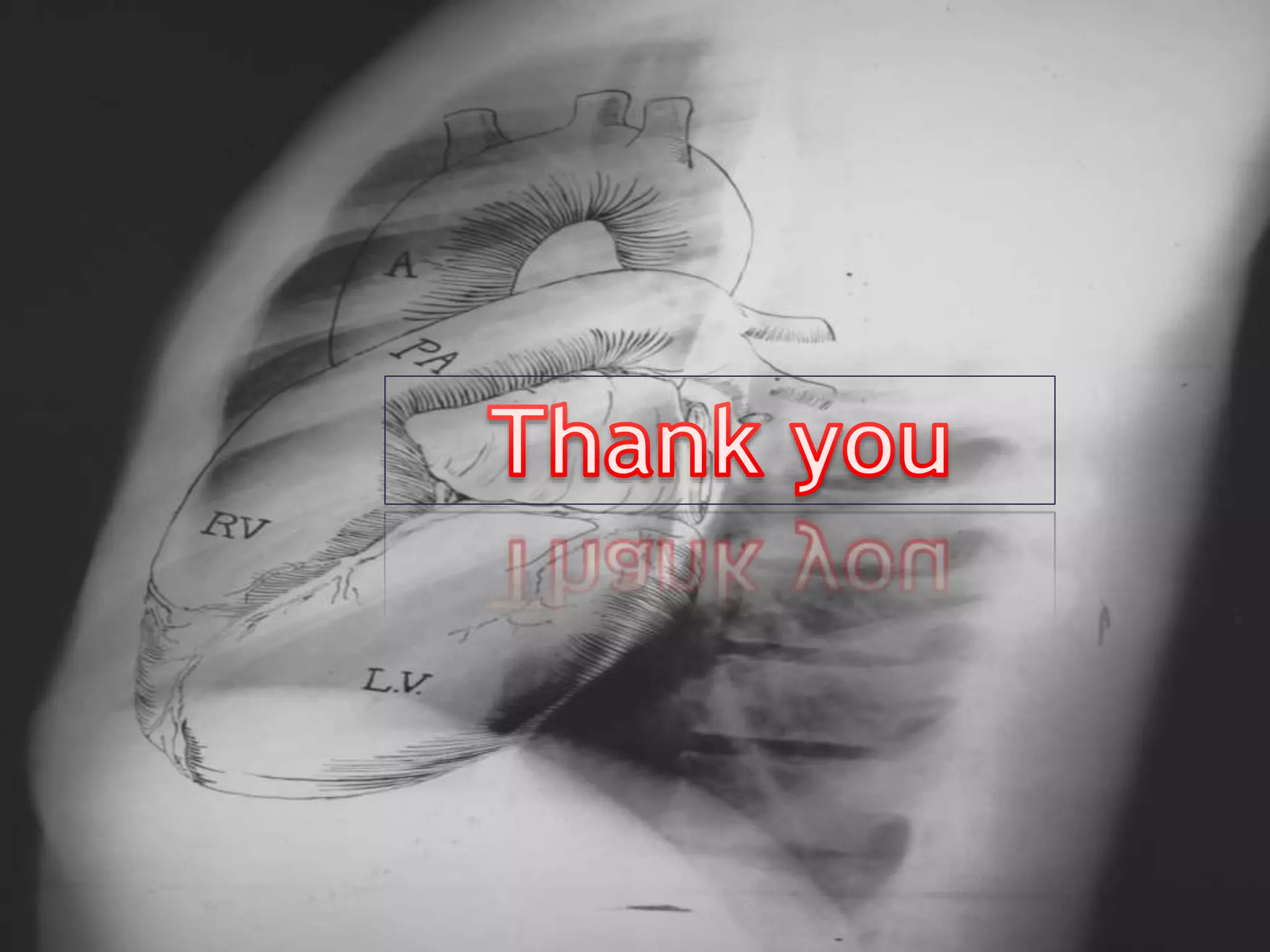 Left ventricular enlargement radiology | PPTX