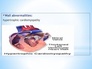 Left ventricular enlargement radiology | PPTX