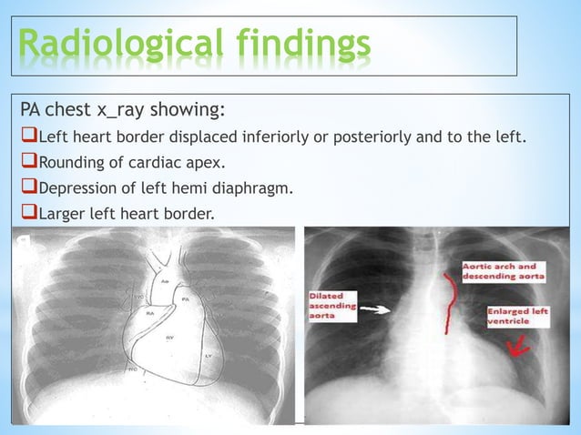 Left ventricular enlargement radiology | PPTX