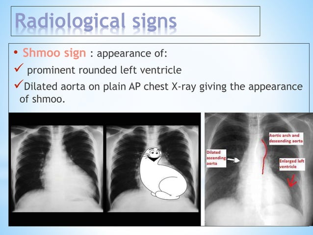 Left ventricular enlargement radiology | PPTX