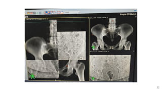 Image Guided Radiation Therapy: Basics | PPTX