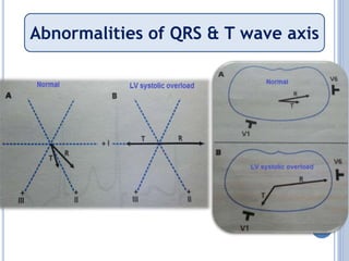 Abnormalities of QRS & T wave axis
 