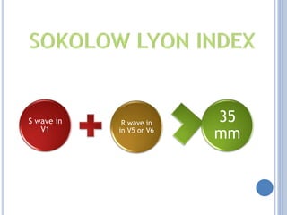 S wave in
V1
R wave in
in V5 or V6
35
mm
 