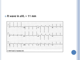  R wave in aVL > 11 mm
 