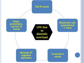Tall R waves
Relatively tall,
symmetrical
T wave
Inverted U
waves
Minimal ST
segment
elevation
Deep,
prominent,
narrow Q
waves
LVH due
to
diastolic
overload
 