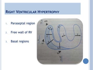 RIGHT VENTRICULAR HYPERTROPHY
1. Paraseptal region
2. Free wall of RV
3. Basal regions
 
