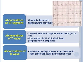 • Minimally depressed
• Slight upward convexity
Abnormalities
of ST segment
• T wave inversion in right oriented leads (V1 to
V4)
• Most marked in V1 V2 & diminishes
progressively in amplitude
Abnormalities
of T wave
• Decreased in amplitude or even inverted in
right precordial leads &/or inferior leads
Abnormalities of
U wave
 