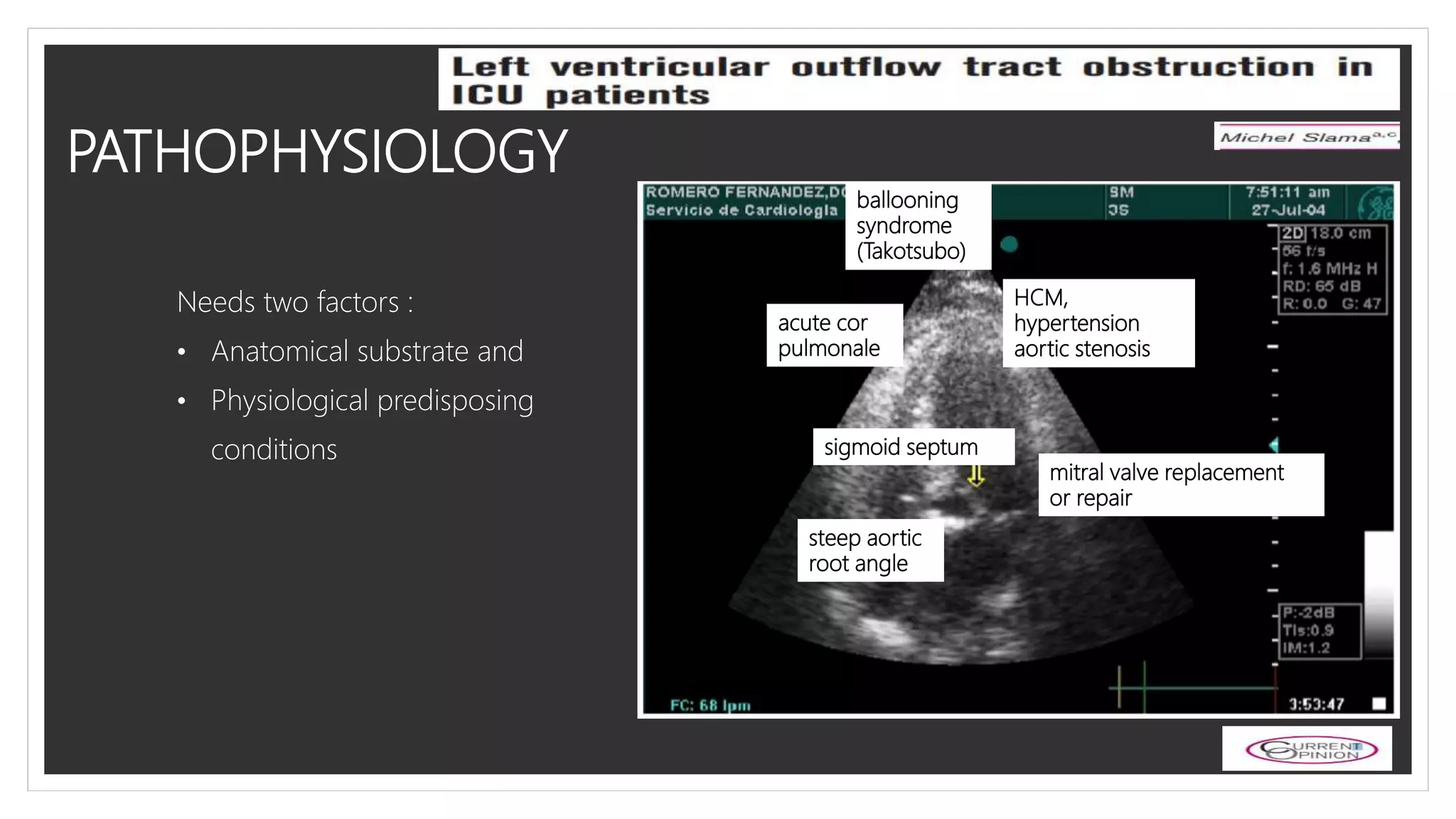 LVOT OBSTRUCTION IN ICU PPTX Heart And Cardiovascular Diseases LVOT OBSTRUCTION IN ICU PPTX Heart And Cardiovascular Diseases