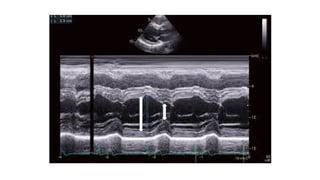 LV RV ASSESSMENT.pptx pocus ultrasound in trauma | PPTX