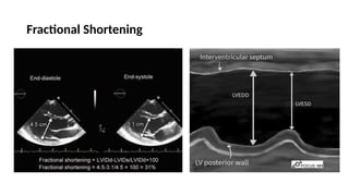 LV RV ASSESSMENT.pptx pocus ultrasound in trauma | PPTX