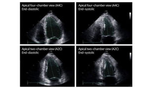 LV RV ASSESSMENT.pptx pocus ultrasound in trauma | PPTX