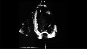 LV RV ASSESSMENT.pptx pocus ultrasound in trauma | PPTX