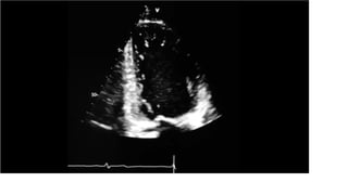 LV RV ASSESSMENT.pptx pocus ultrasound in trauma | PPTX