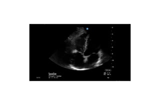 LV RV ASSESSMENT.pptx pocus ultrasound in trauma | PPTX