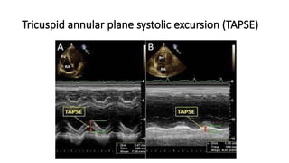 LV RV ASSESSMENT.pptx pocus ultrasound in trauma | PPTX