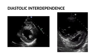 LV RV ASSESSMENT.pptx pocus ultrasound in trauma | PPTX