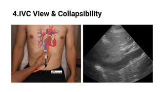 LV RV ASSESSMENT.pptx pocus ultrasound in trauma | PPTX