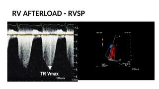 LV RV ASSESSMENT.pptx pocus ultrasound in trauma | PPTX