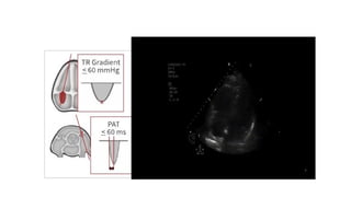 Functional Lv Rv LV RV ASSESSMENT.pptx pocus ultrasound in trauma | PPTX