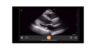 LV RV ASSESSMENT.pptx pocus ultrasound in trauma | PPTX