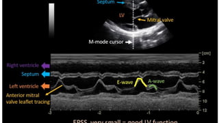 LV RV ASSESSMENT.pptx pocus ultrasound in trauma | PPTX