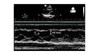 LV RV ASSESSMENT.pptx pocus ultrasound in trauma | PPTX