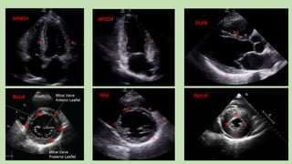 LV segment and regional study on ECHO 4.pptx