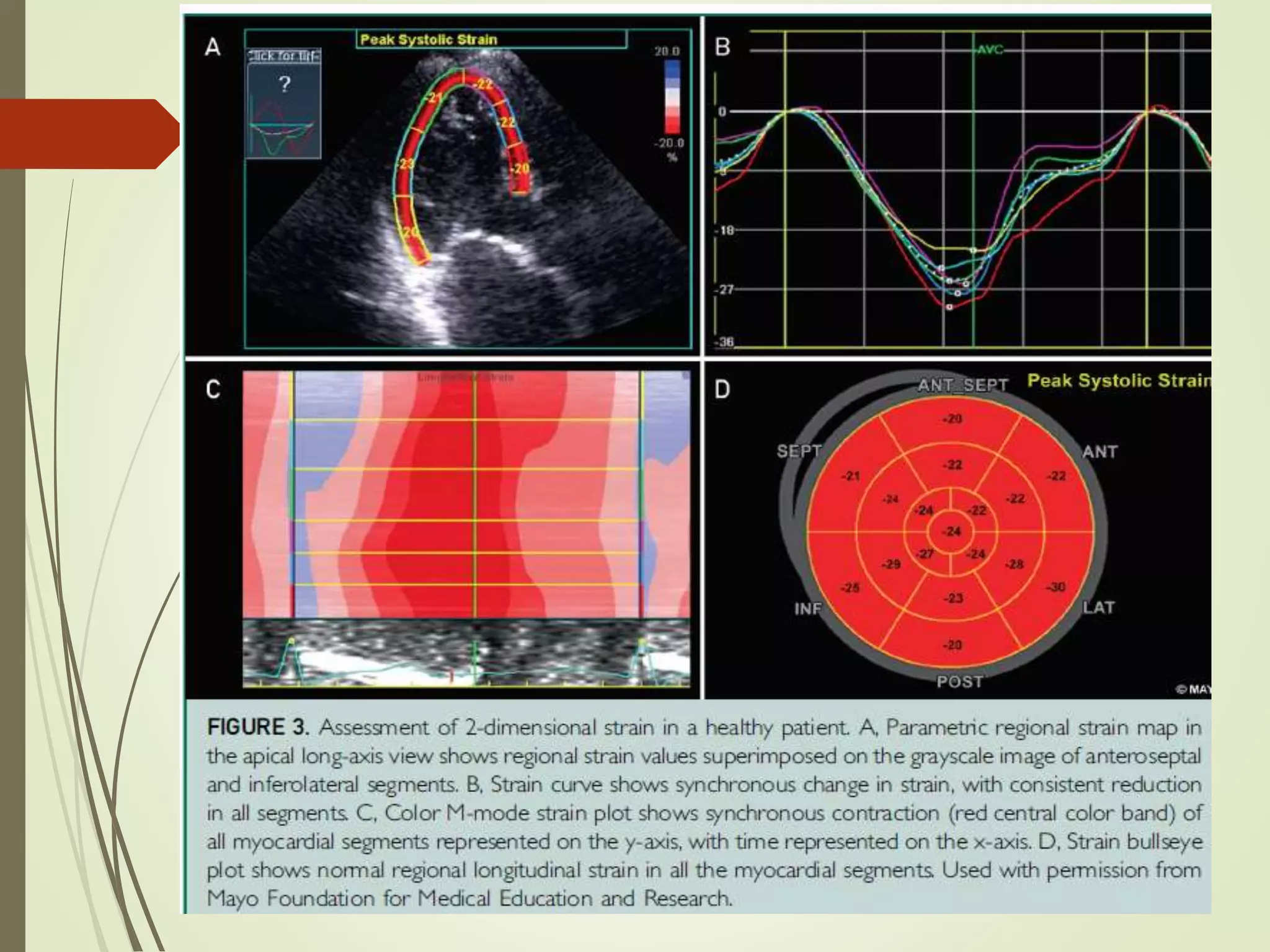 Lv Systolic Function Pptx