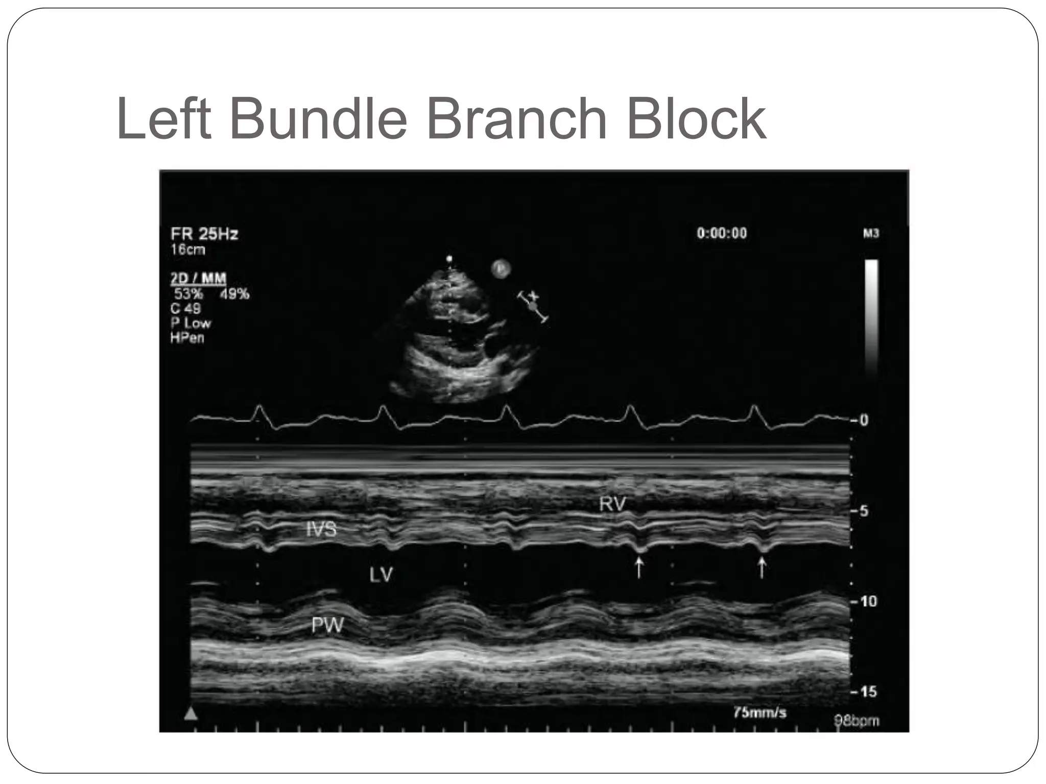 Lv Systolic Function Pptx