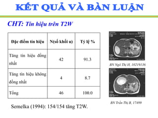 CHT: Tín hiệu trên T2W
Semelka (1994): 154/154 tăng T2W.
Đặc điểm tín hiệu N(số khối u) Tỷ lệ %
Tăng tín hiệu đồng
nhất
42 91.3
Tăng tín hiệu không
đồng nhất
4 8.7
Tổng 46 100.0
BN Ngô Thị H, 10219136
BN Trần Thị B, 17499
 