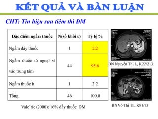 CHT: Tín hiệu sau tiêm thì ĐM
BN Võ Thị Th, K91/73
BN Nguyễn Thị L, K22/213
Đặc điểm ngấm thuốc N(số khối u) Tỷ lệ %
Ngấm đầy thuốc 1 2.2
Ngấm thuốc từ ngoại vi
vào trung tâm
44 95.6
Ngấm thuốc ít 1 2.2
Tổng 46 100.0
Vale’rie (2000): 16% đầy thuốc ĐM
 