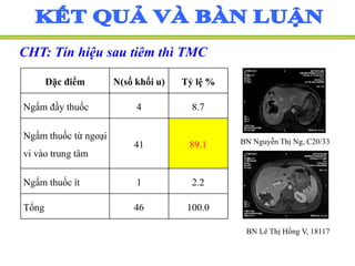 CHT: Tín hiệu sau tiêm thì TMC
BN Nguyễn Thị Ng, C20/33
Đặc điểm N(số khối u) Tỷ lệ %
Ngấm đầy thuốc 4 8.7
Ngấm thuốc từ ngoại
vi vào trung tâm
41 89.1
Ngấm thuốc ít 1 2.2
Tổng 46 100.0
BN Lê Thị Hồng V, 18117
 