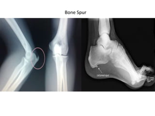 Spur Injury Approach to arthritis | PPTX