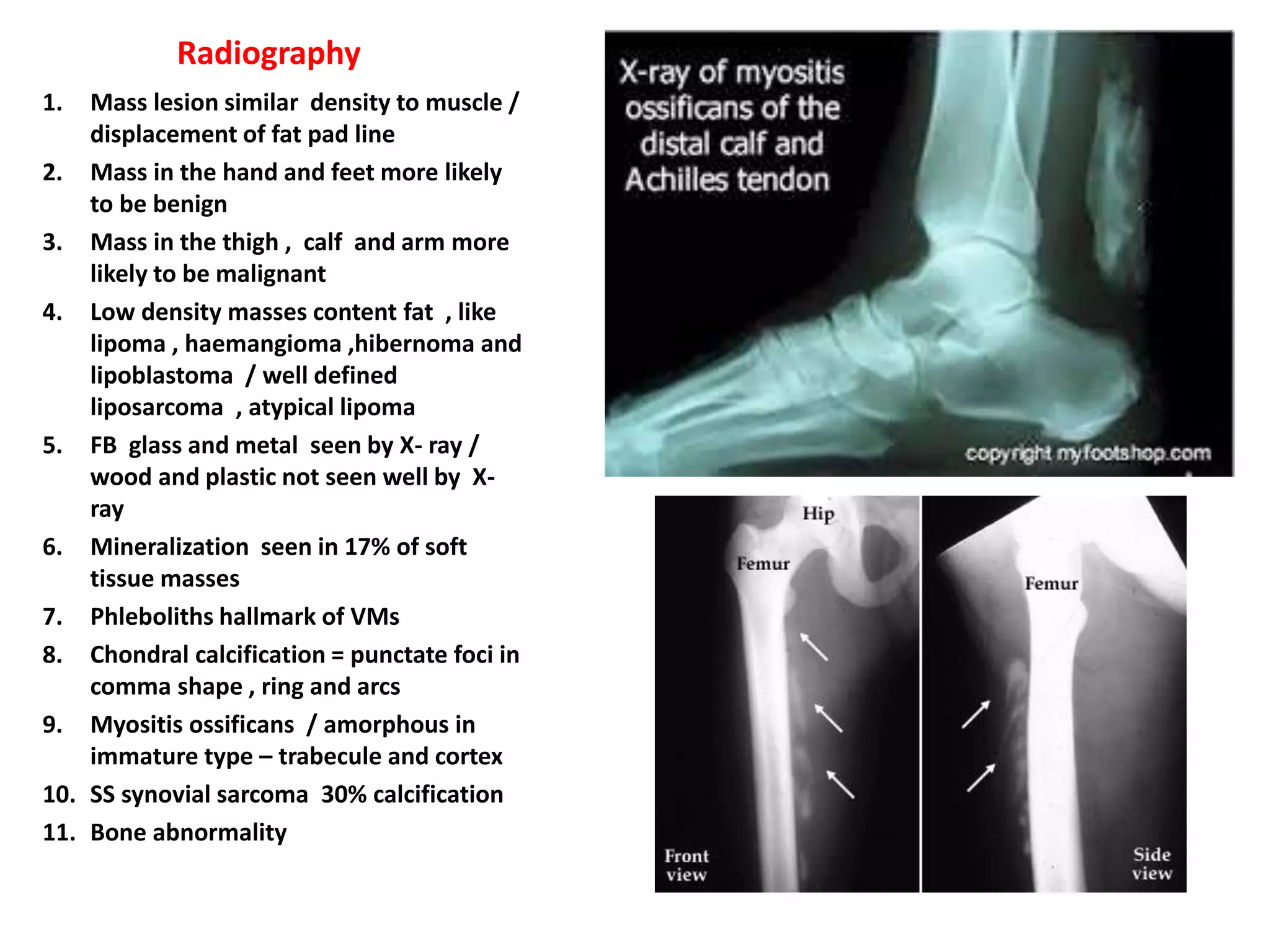 Soft tissue tumours | PPTX