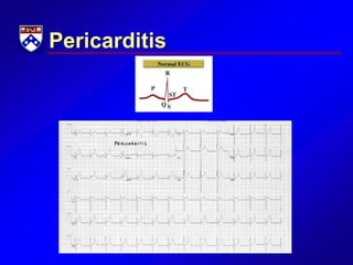 Pericarditis
 