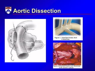 Aortic Dissection
 