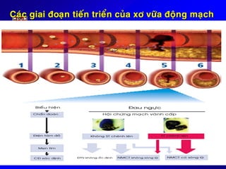 Caùc giai ñoaïn tieán trieån cuûa xô vöõa ñoäng maïch
 