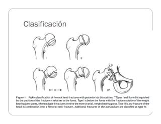 Manejo
Permanece controversial
Manejo ortopédico
Reducción anatómica (desplazamiento < 2 mm)
Ausencia de cuerpos libres
Ar...