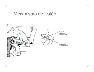 Mecanismo de lesión
 