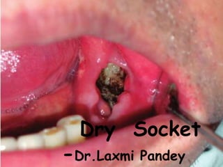 DRY SOCKET
Dry Socket
-Dr.Laxmi Pandey
 